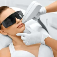 Upper Lip and Chin Laser Hair Reduction